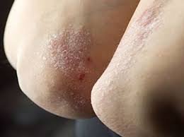Diseases related to psoriasis